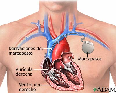 marcapasos